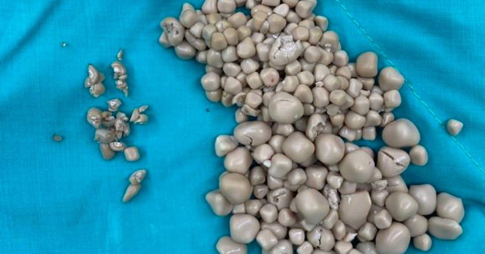 Ein Chirurg in Taiwan entfernte Hunderte kleine Steinchen aus den Nieren einer 20-jährigen Frau.