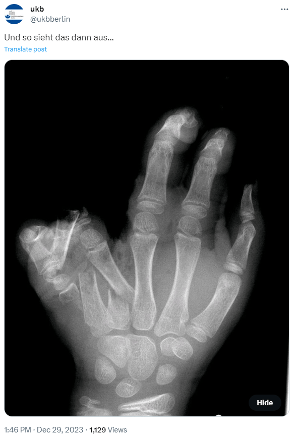 Dazu postete das Spital ein Röntgenbild einer zerfetzten Hand vom 29. Dezember.