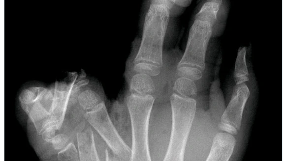 Dazu postete das Spital ein Röntgenbild einer zerfetzten Hand vom 29. Dezember.