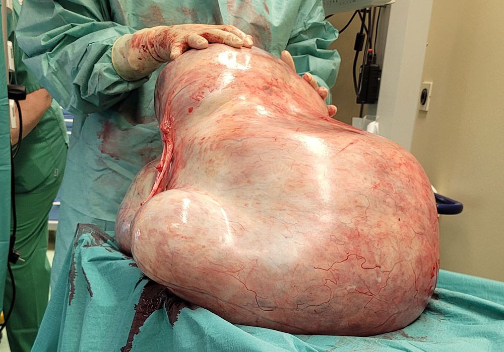 Das 32 Kilogramm schwere Zystadenom nach der Entfernung