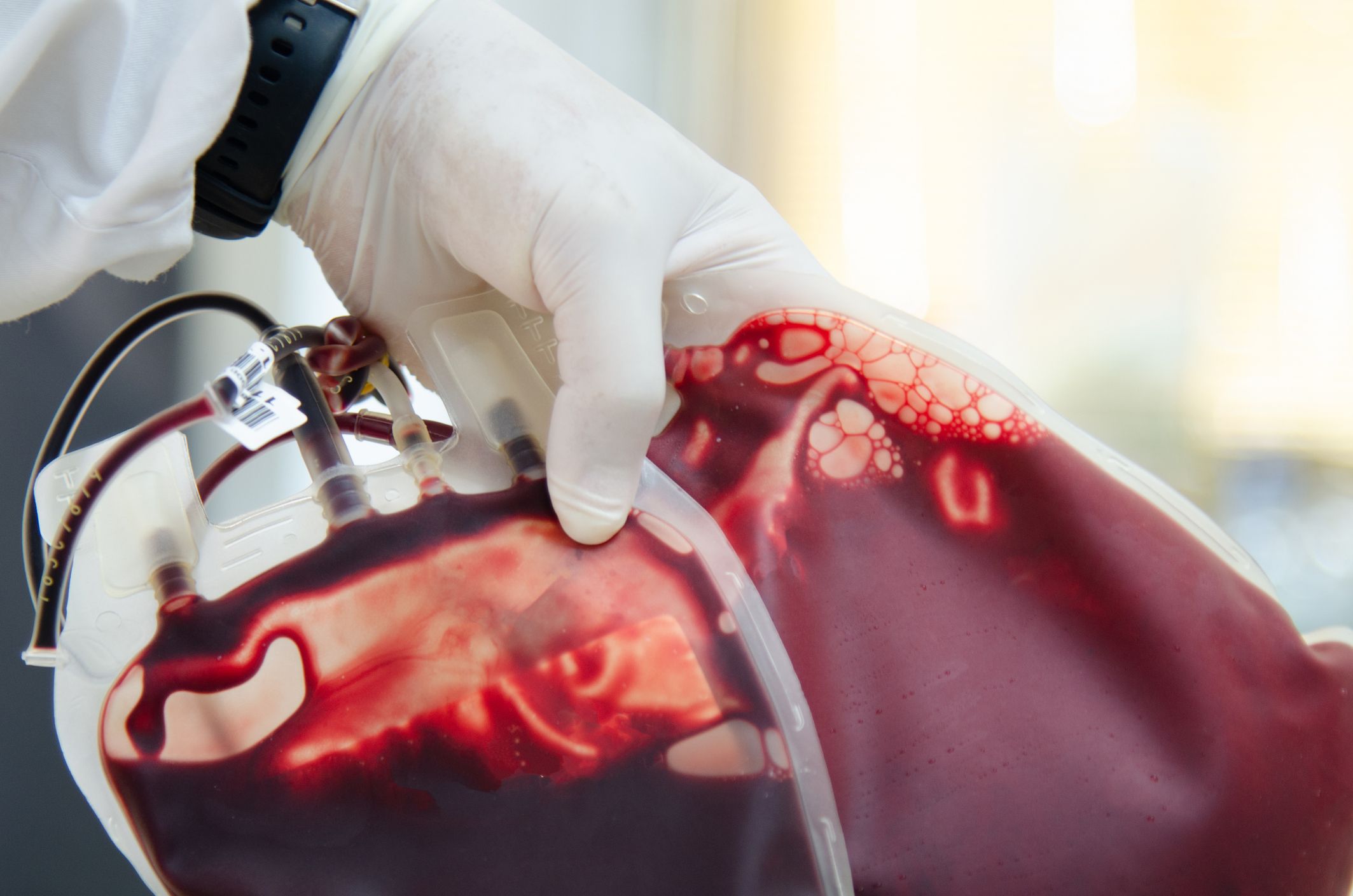 Aktuell gibt es besonders viele Krankenstände, Blutkonserven sind daher Mangelware.