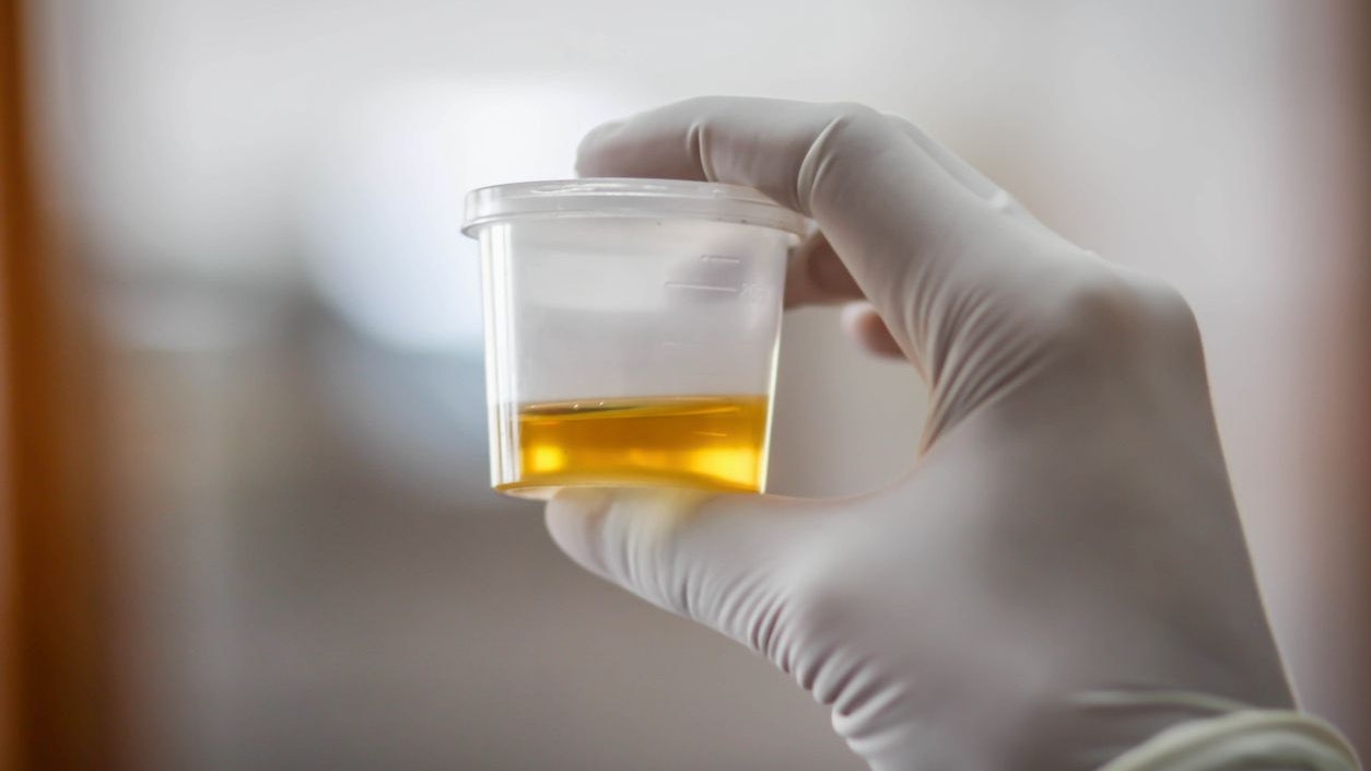 Urine sample