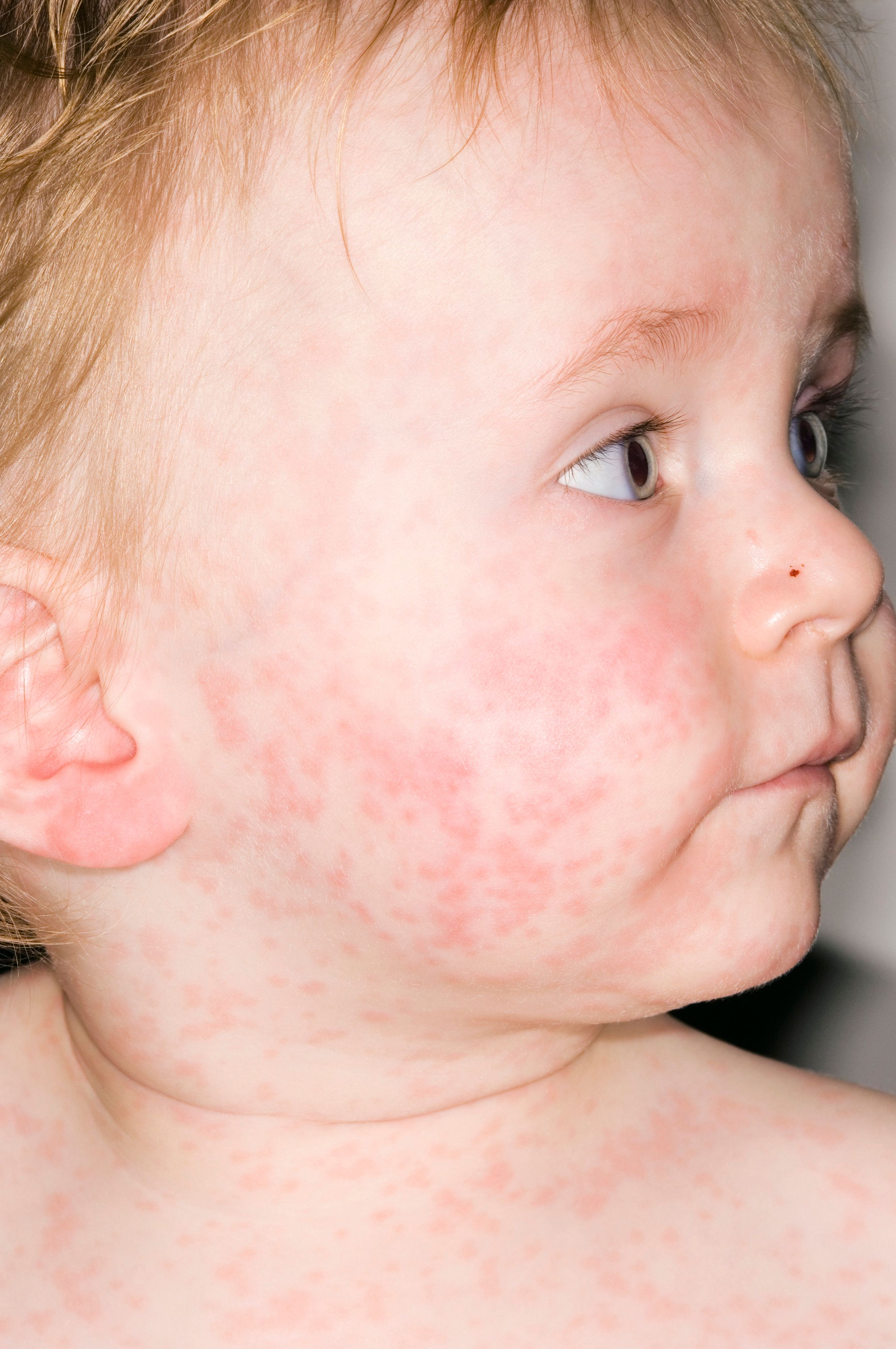 Die Masern verursachen einen typischen Ausschlag. Doch schon bevor dessen Ausbruch, ist die infizierte Person ansteckend.