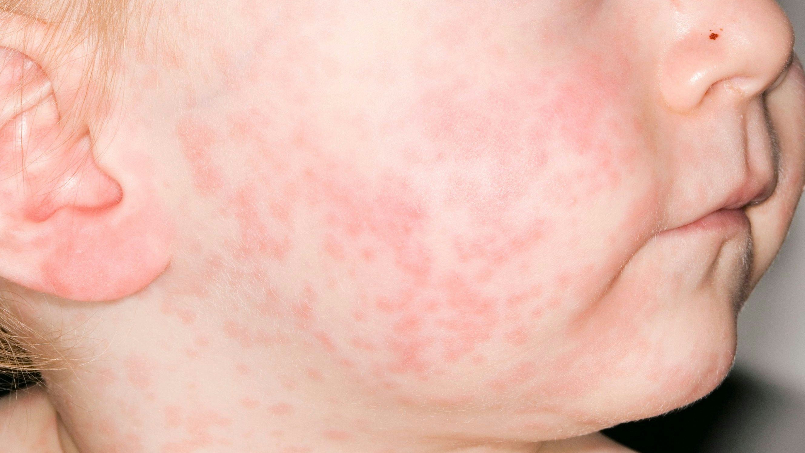 Download von www.picturedesk.com am 18.01.2024 (23:28).  MODEL RELEASED. Measles rash on a 1 year old boy's face. Measles, also called morbilli or rubeola, is a highly infectious viral disease. It mainly affects children, but can occur at any age and the adult form is more severe. An attack usually gives lifelong immunity. Complications include ear and chest infections, diarrhoea and vomiting. Recovery takes 2-4 weeks. Treatment includes drinking lots of fluids and rest. Vaccination against measles provides effective immunity. For a view of measles on this boy's back, see image M210/444. - 20080829_PD3855 - Rechteinfo: Rights Managed (RM) Model Released
