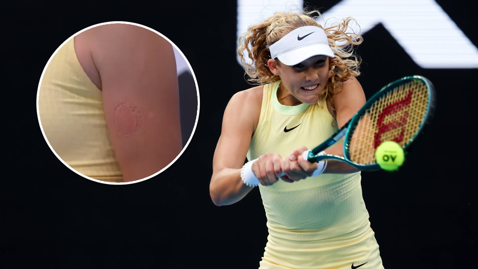 Tennis-Star beißt sich vor Ärger selbst in den Arm