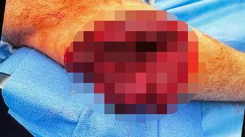 Die tiefe Wunde zeigen wir nur grob verpixelt. Auf dem Insta-Profil von Kilde zeigt der Sportler das Innenleben seines Beines gestochen scharf …