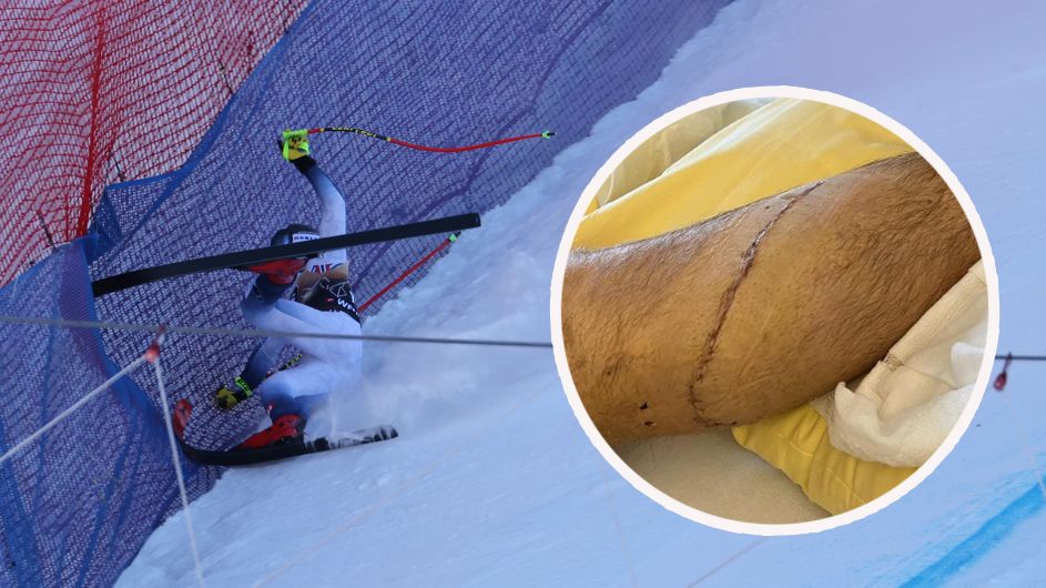 Aleks Kilde zeigt seine Narbe am Unterschenkel.