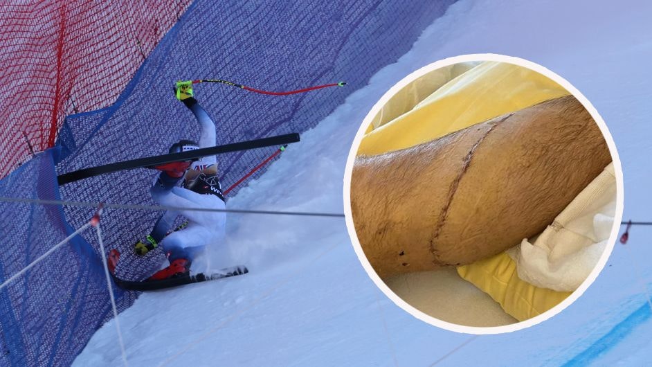 Aleks Kilde zeigt seine Narbe am Unterschenkel.