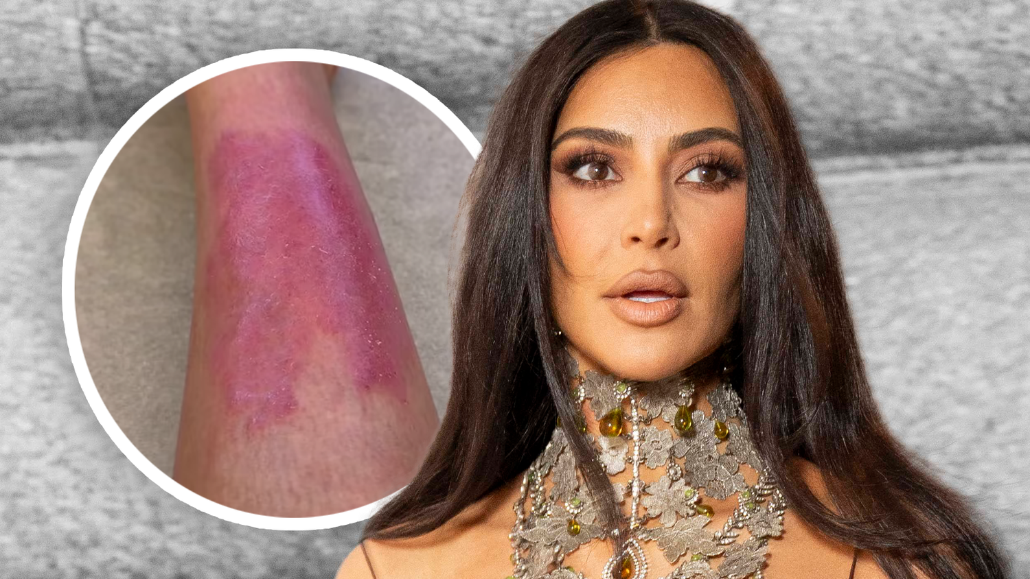 Kim Kardashian spricht auf Insta über ihre Hautkrankheit.