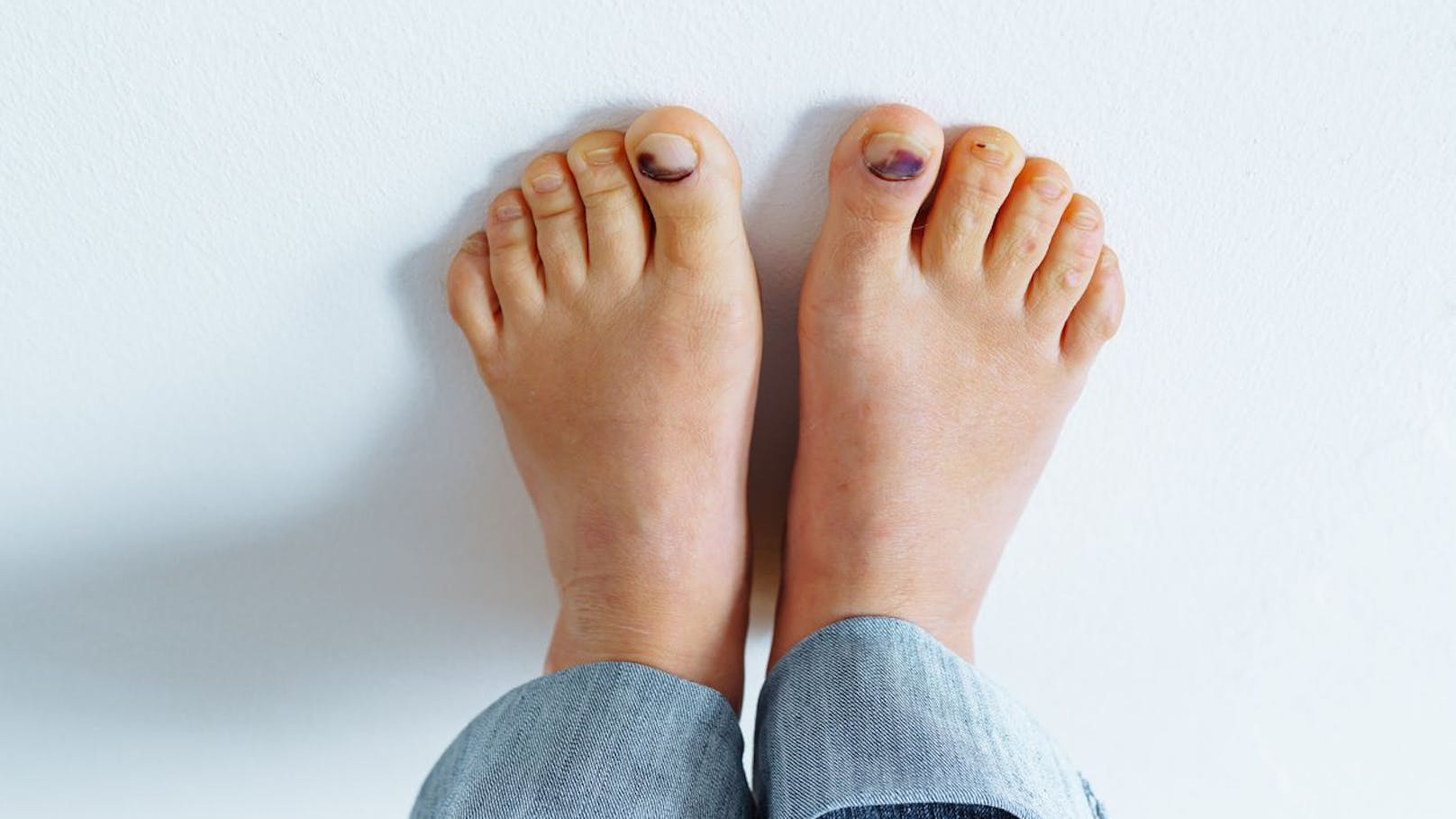 <strong>Nagelflecken:</strong> Flecken unter dem Zehennagel können ein Anzeichen für Schuppenflechte, eine Pilzinfektion, Dermatitis und auch ein Hinweis auf ein Melanom sein. Dunkle vertikale Streifen entstehen durch Hormonverschiebungen in der Schwangerschaft oder durch die Verwendung von Nagellack. Sie können aber auch auf ein Melanom (Hautkrebs) hinweisen und eine Pilzinfektion wie Fußpilz im Nagelbett anzeigen.