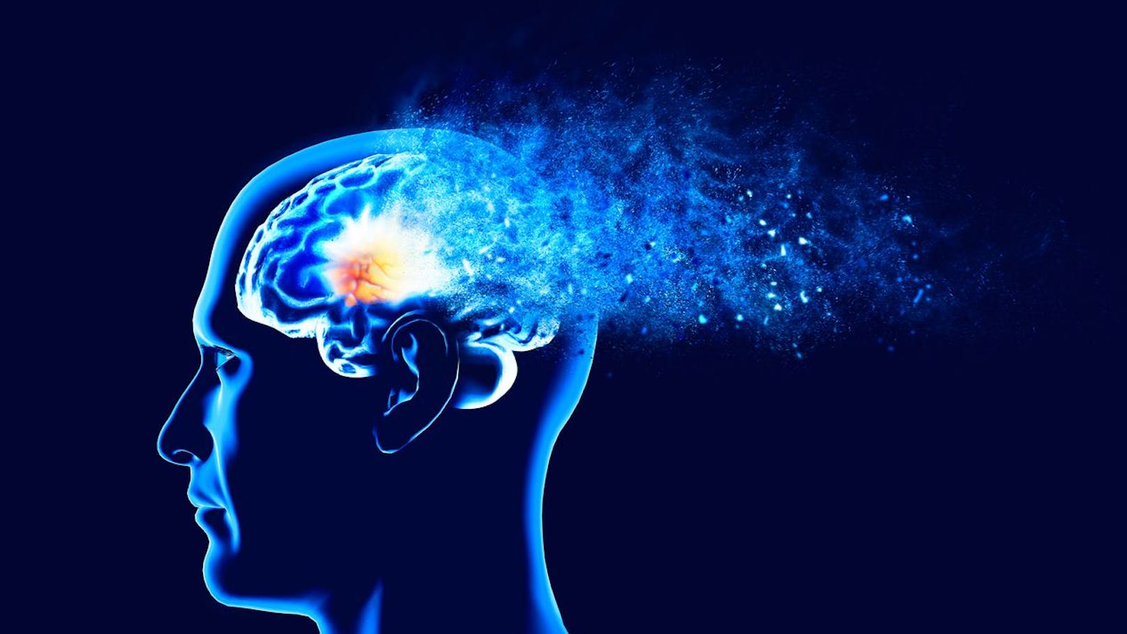 Alzheimer kann übertragbar sein – laut Studie