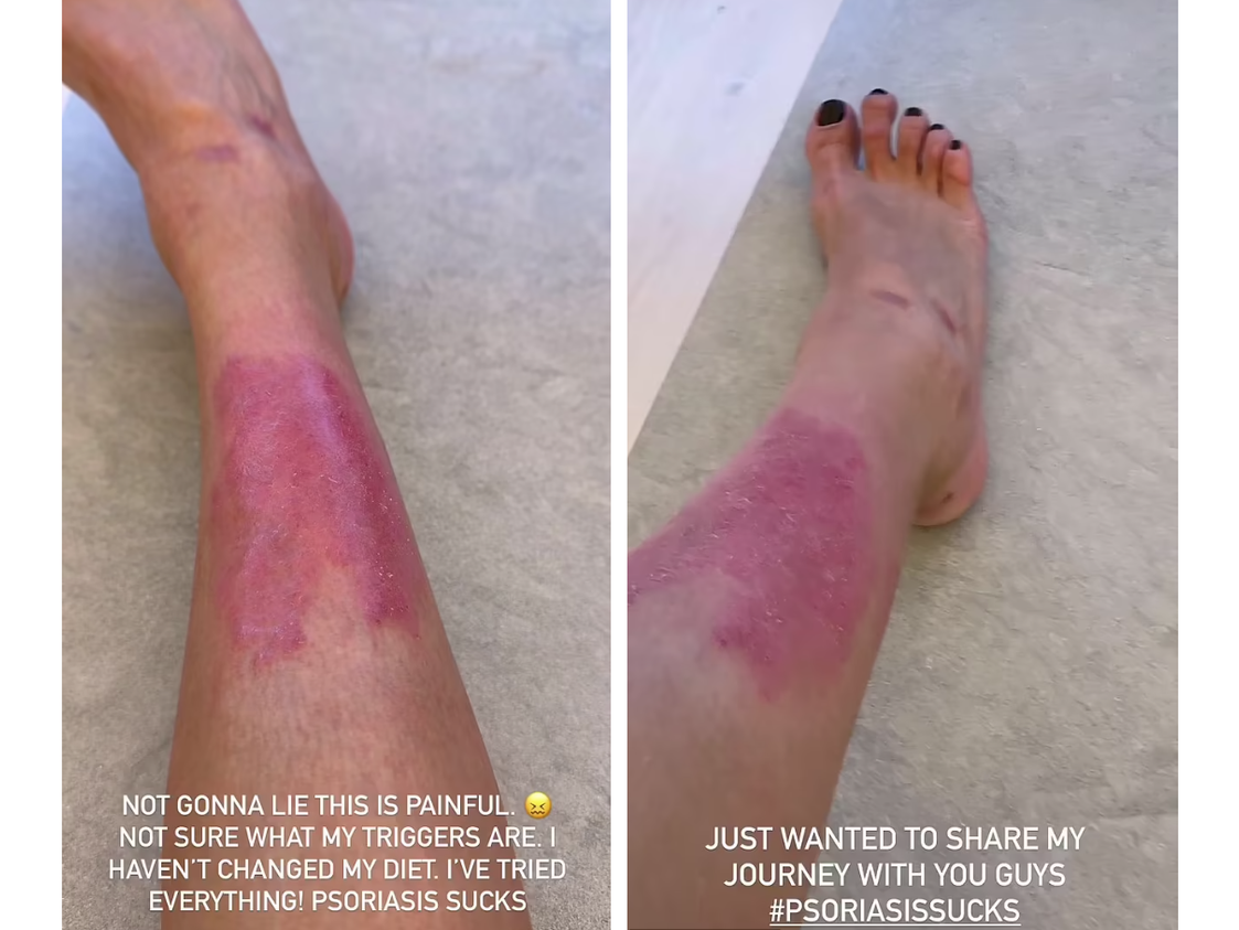 Kim Kardashian zeigt ihre Schuppenflechte.