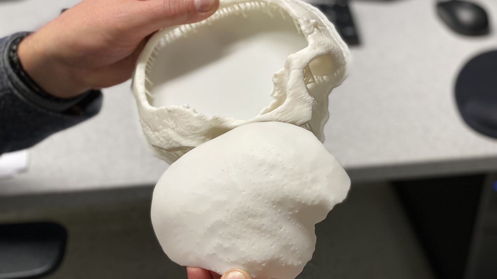 Bub erhielt Kunststoff-Schädeldecke aus 3D-Drucker