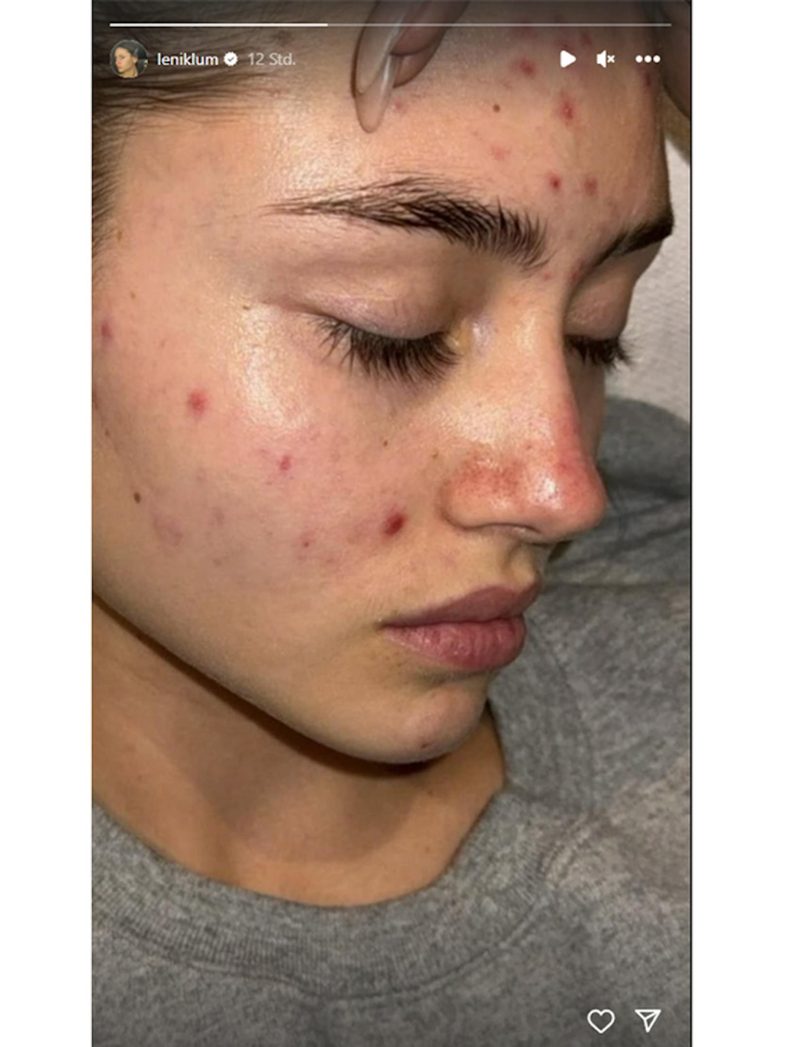 Leni Klum zeigt sich in ihrer Instagram-Story mit zahlreichen Unreinheiten im Gesicht.