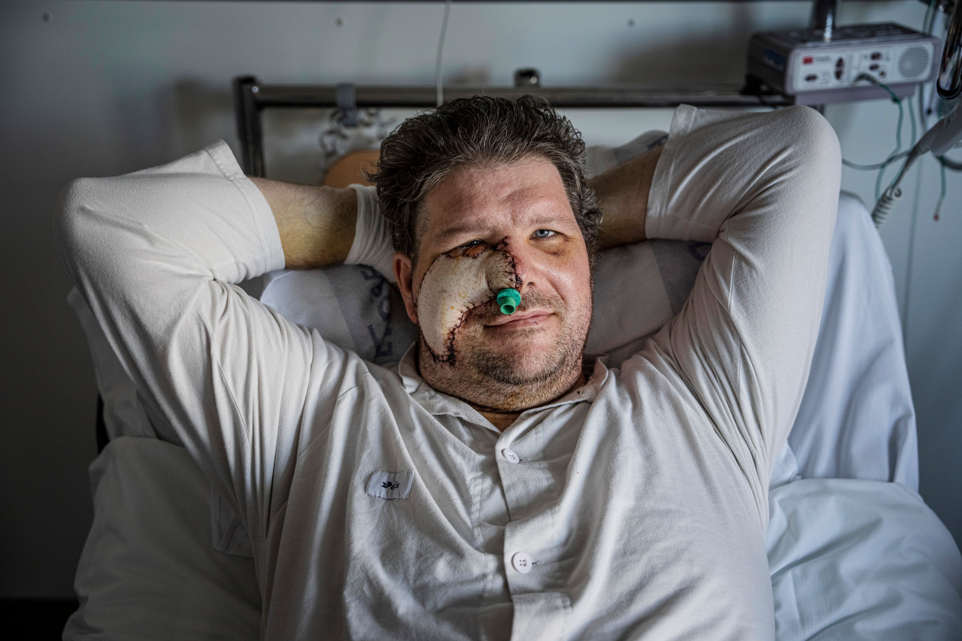 Der Schwede nach dem Bärenangriff: Er verlor seine rechte Wange