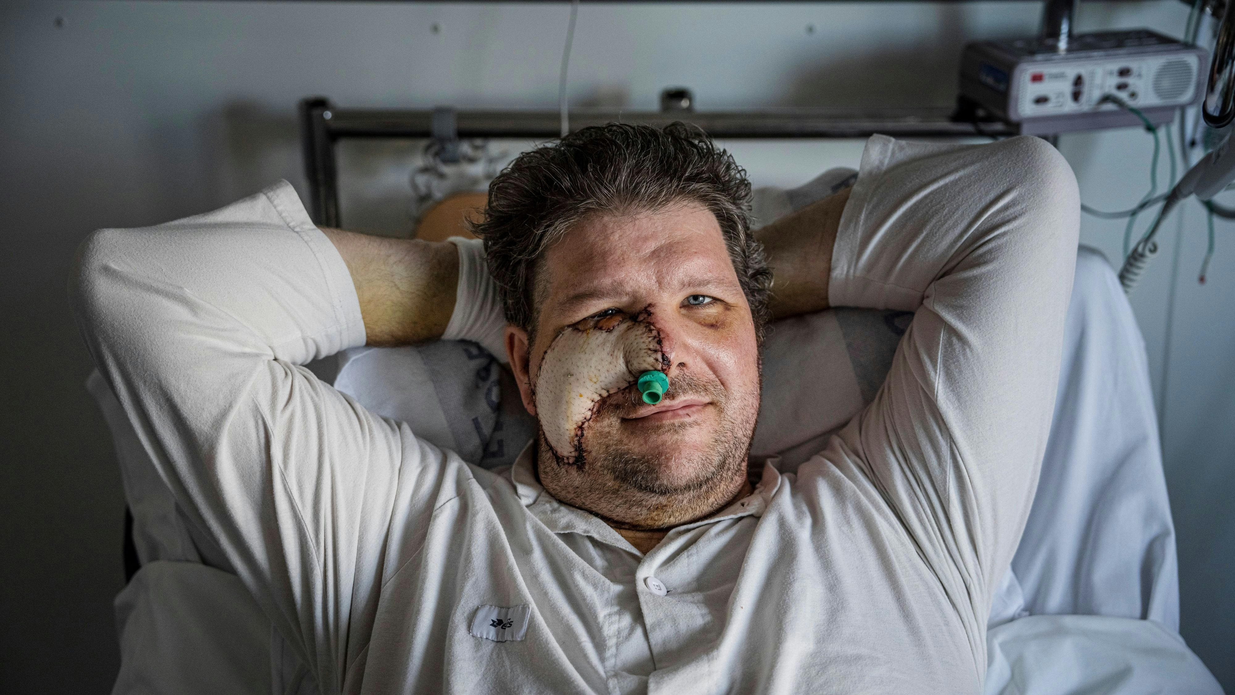 Der Schwede nach dem Bärenangriff: Er verlor seine rechte Wange