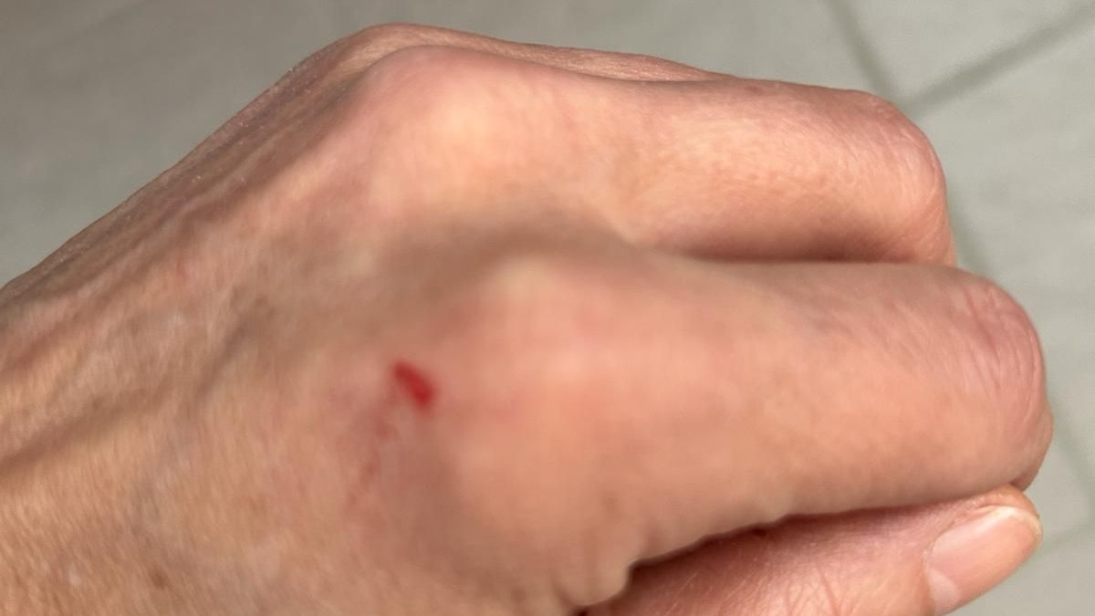 Am nächsten Morgen bemerkte die Wienerin die Wunde auf ihrer Hand.