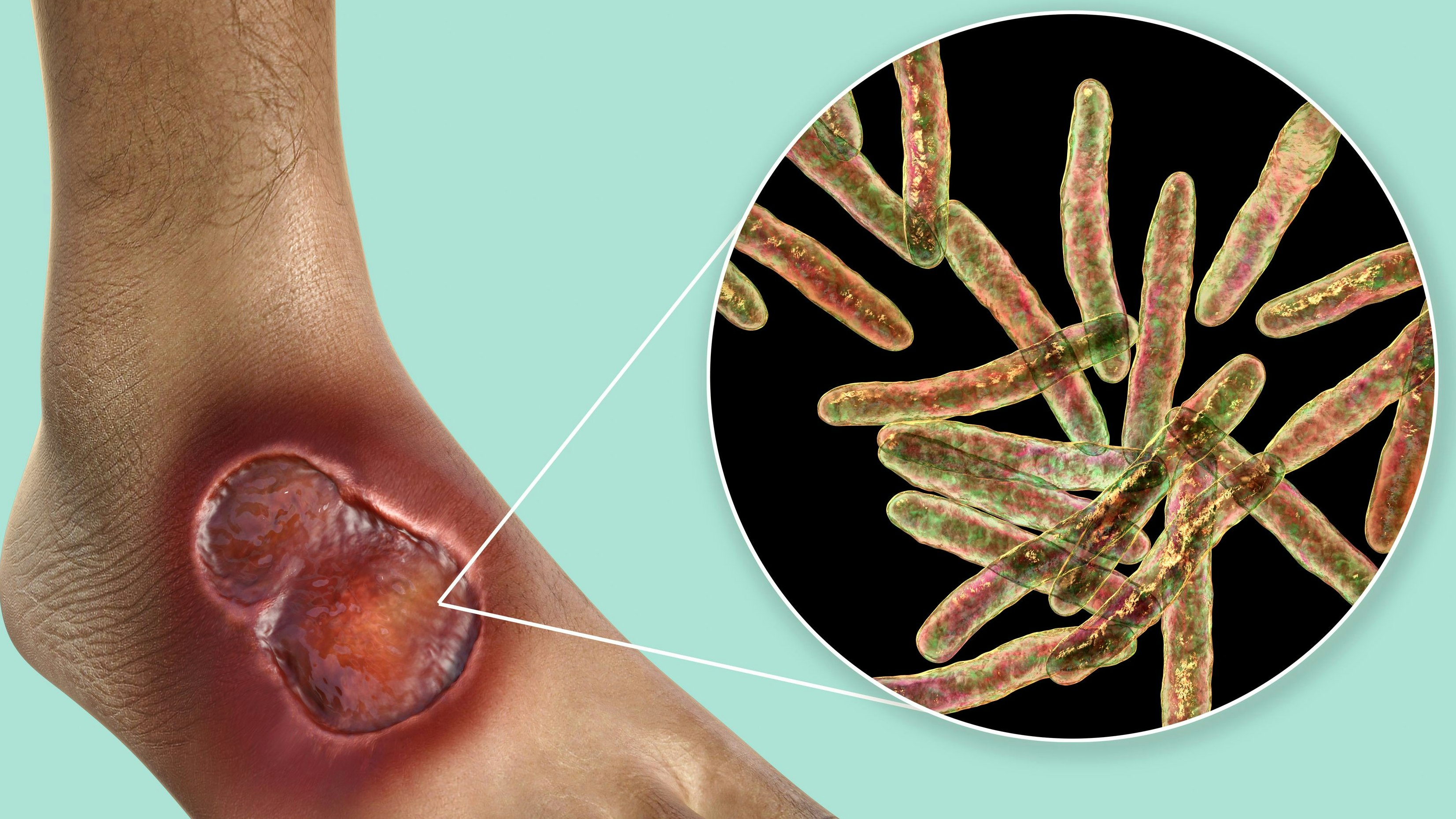 Download von www.picturedesk.com am 13.02.2024 (15:52).  Illustration of a buruli ulcer on a foot with a close-up view of Mycobacterium ulcerans, the bacterium that causes the disease. - 20230325_PD1551 - Rechteinfo: Royalty Free (RF)