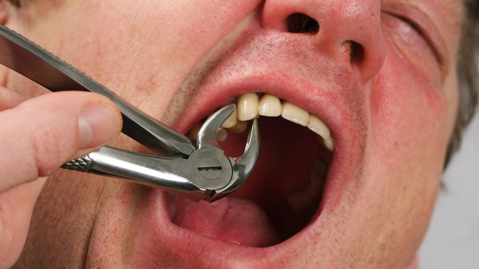 Zu wenige Zahnärzte – Mann zieht sich Zahn mit Zange
