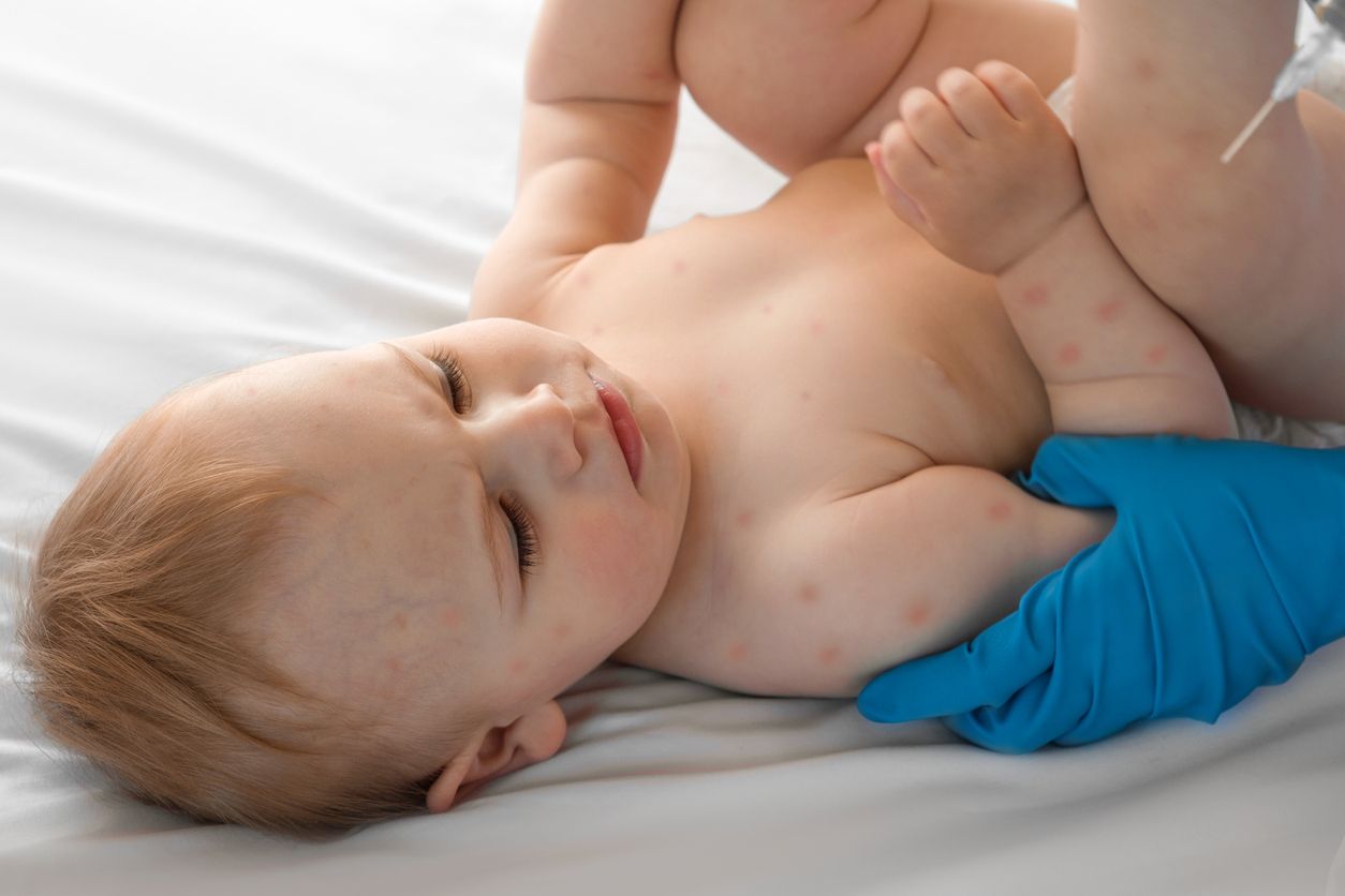 Die Masernfälle steigen. Österreich liegt mittlerweile auf Platz 2 in Europa.