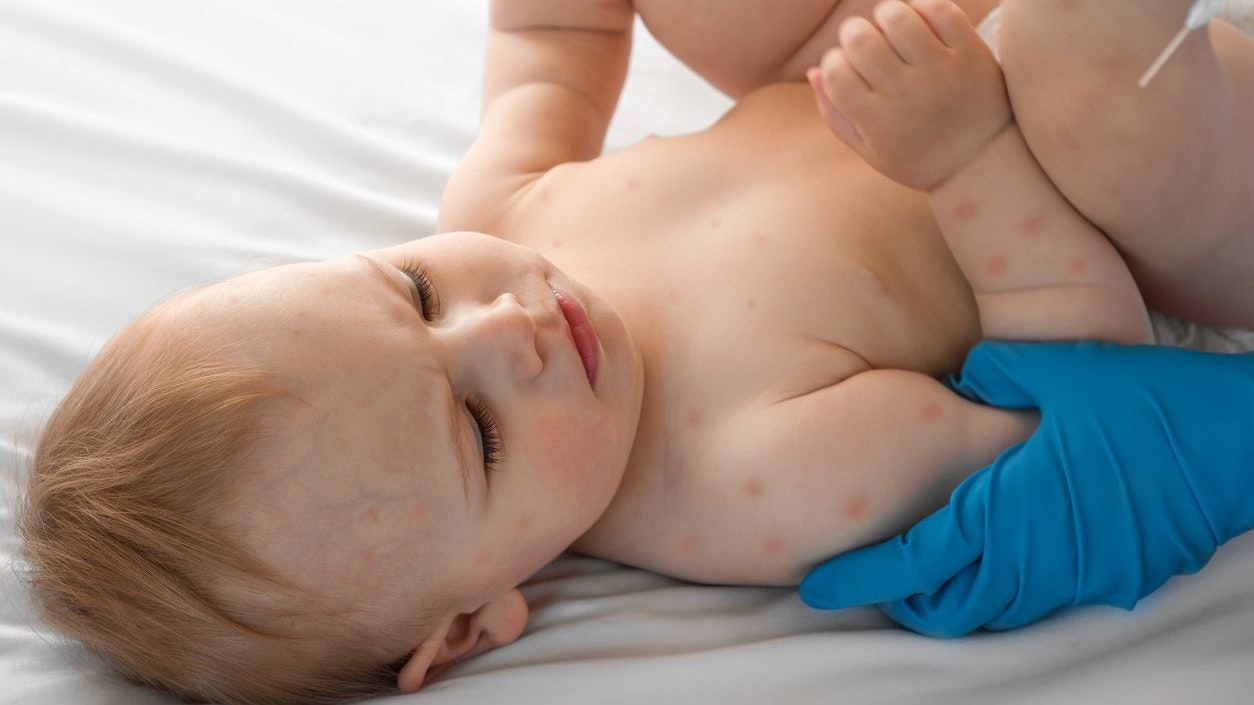 Doctor Checking Skin of Sick Girl. Kid with Red Rash being Examined at the Physician. Allergic Rash, Chicken pox, Monkeypox Symptoms on the Body of Child. Health Problem. Bacterial Infections, Disease. Small Child with Red Rash. Baby with Red Spots Blisters on the skin. Close up of Painful Rash. Health Problem. Rubella, Chickenpox, Scarlet fever, Measles. Bacterial Infections, Disease.