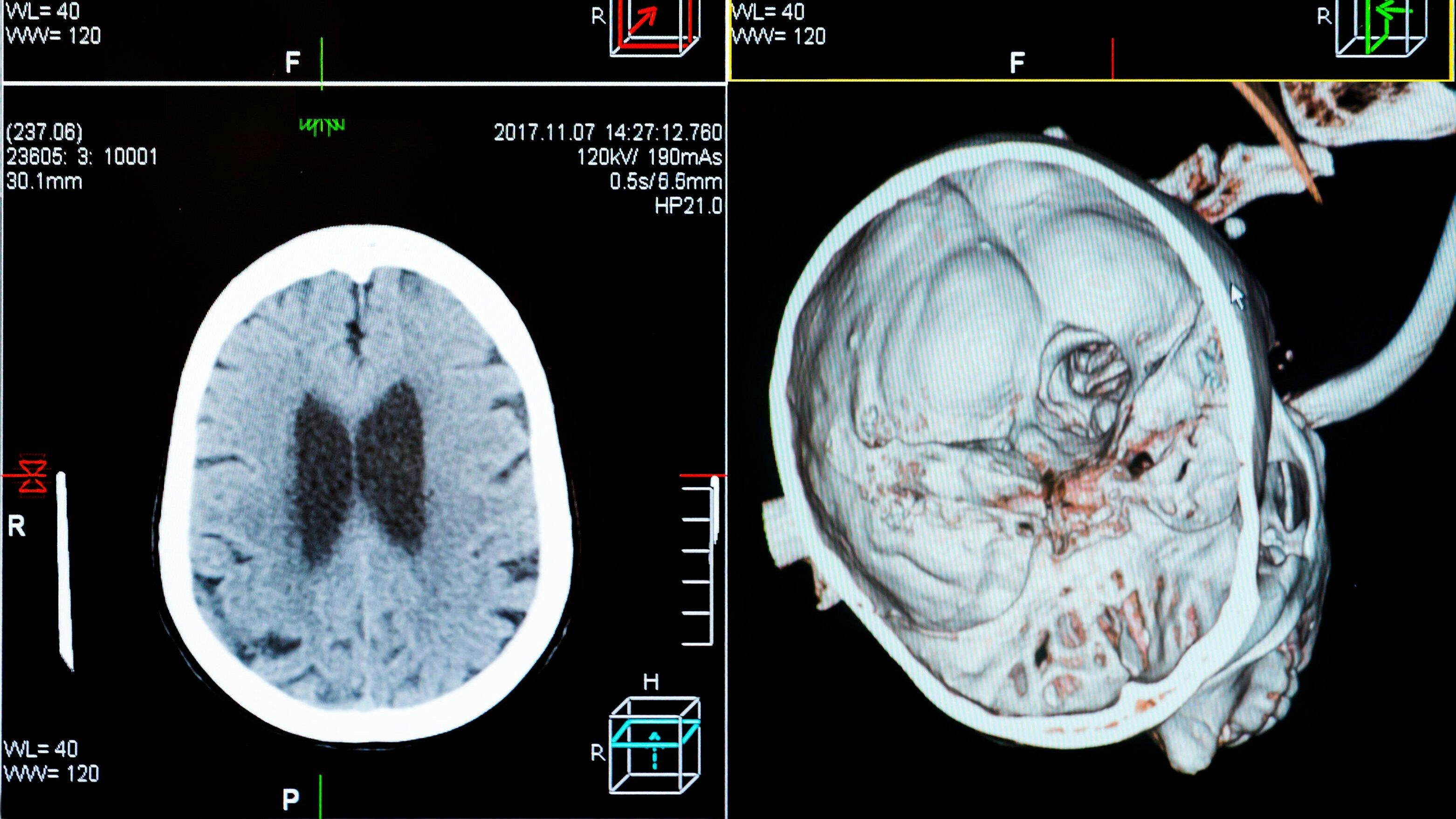 Ein Bub aus Belgien litt an einem "diffusen intrinsischen Ponsgliom" (DIPG), einer sehr aggressiven und bösartigen Form von Hirntumor, die vor allem Kinder betrifft. (Symbolbilder)