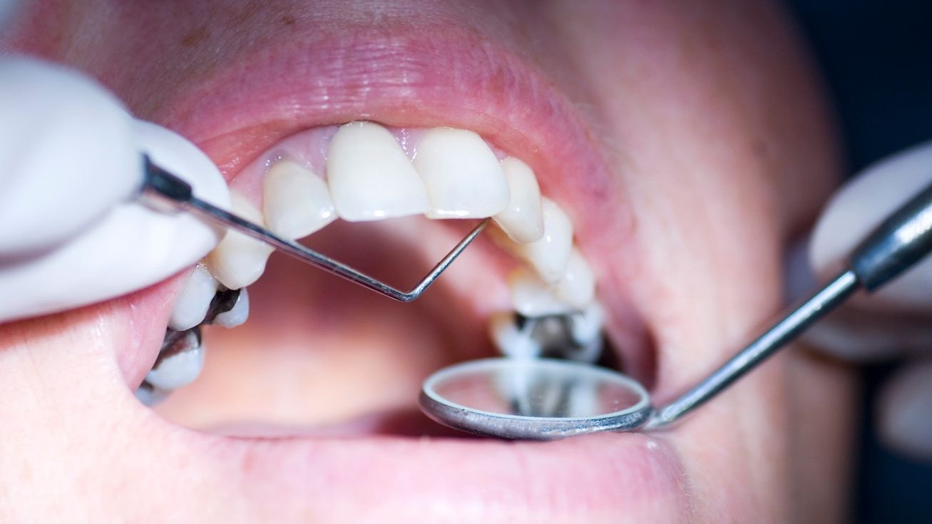 "patient having a dental examination  up, close up with narrow depth of field focus on probe"