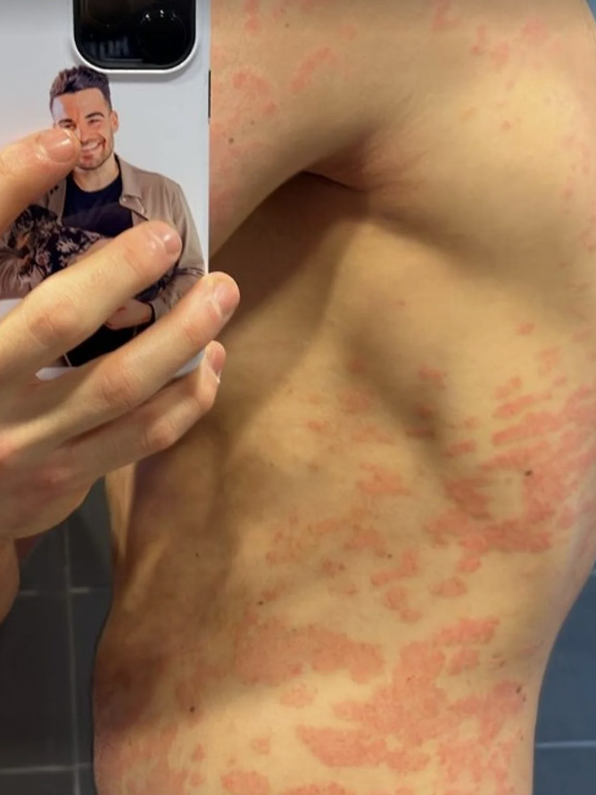 Stefano Zarrella geht offen mit seiner Hautkrankheit um.