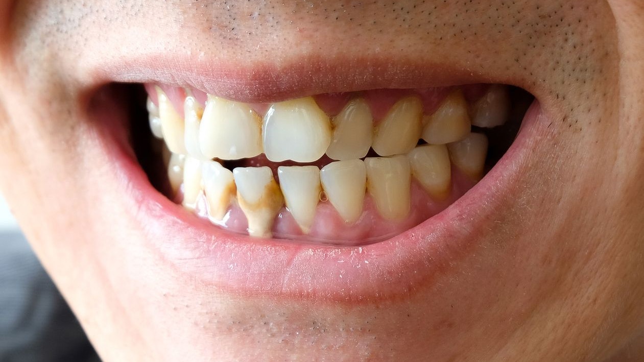 Tooth's a man smoking bad. Man smokes a cigarettes have tooth decay and calculus on teeth, So we should be care dental with the hygiene.