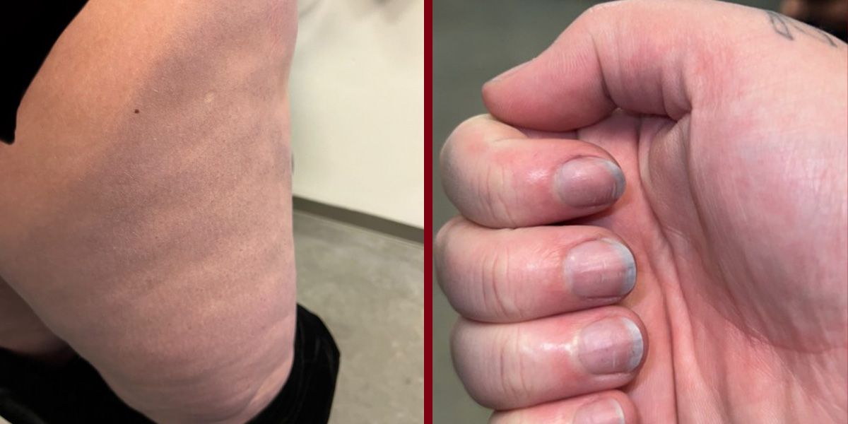 Die Blaufärbung auf ihren Beinen und Fingern (Bild) versetzte Malin Haraldsen in Panik.