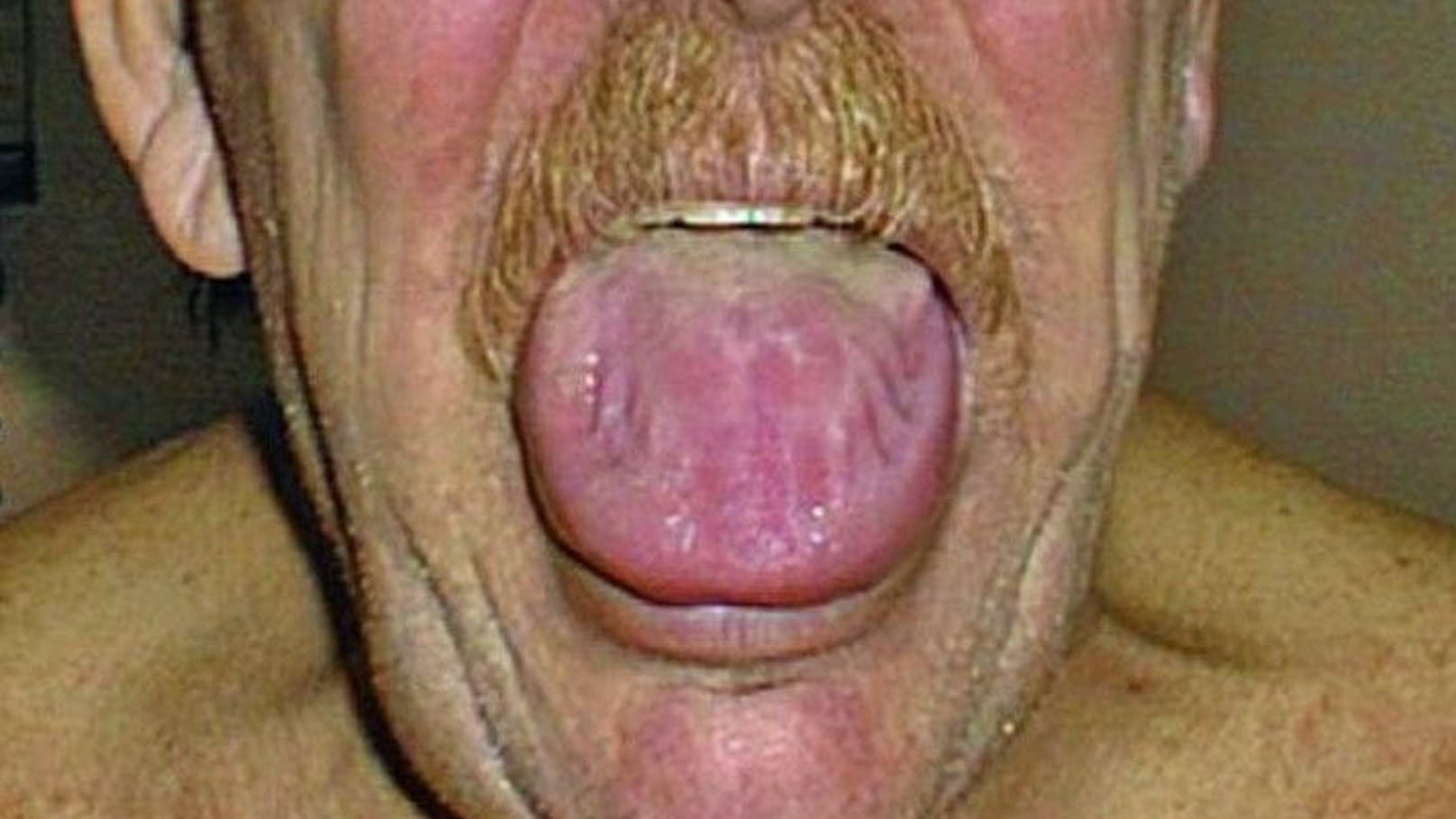 Hast du eine gewellte Zunge? Das könnte dahinterstecken