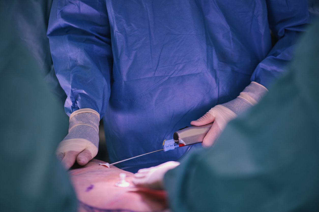 Die Frau starb während des Eingriffs an einem Herzinfarkt (Symbolbild).