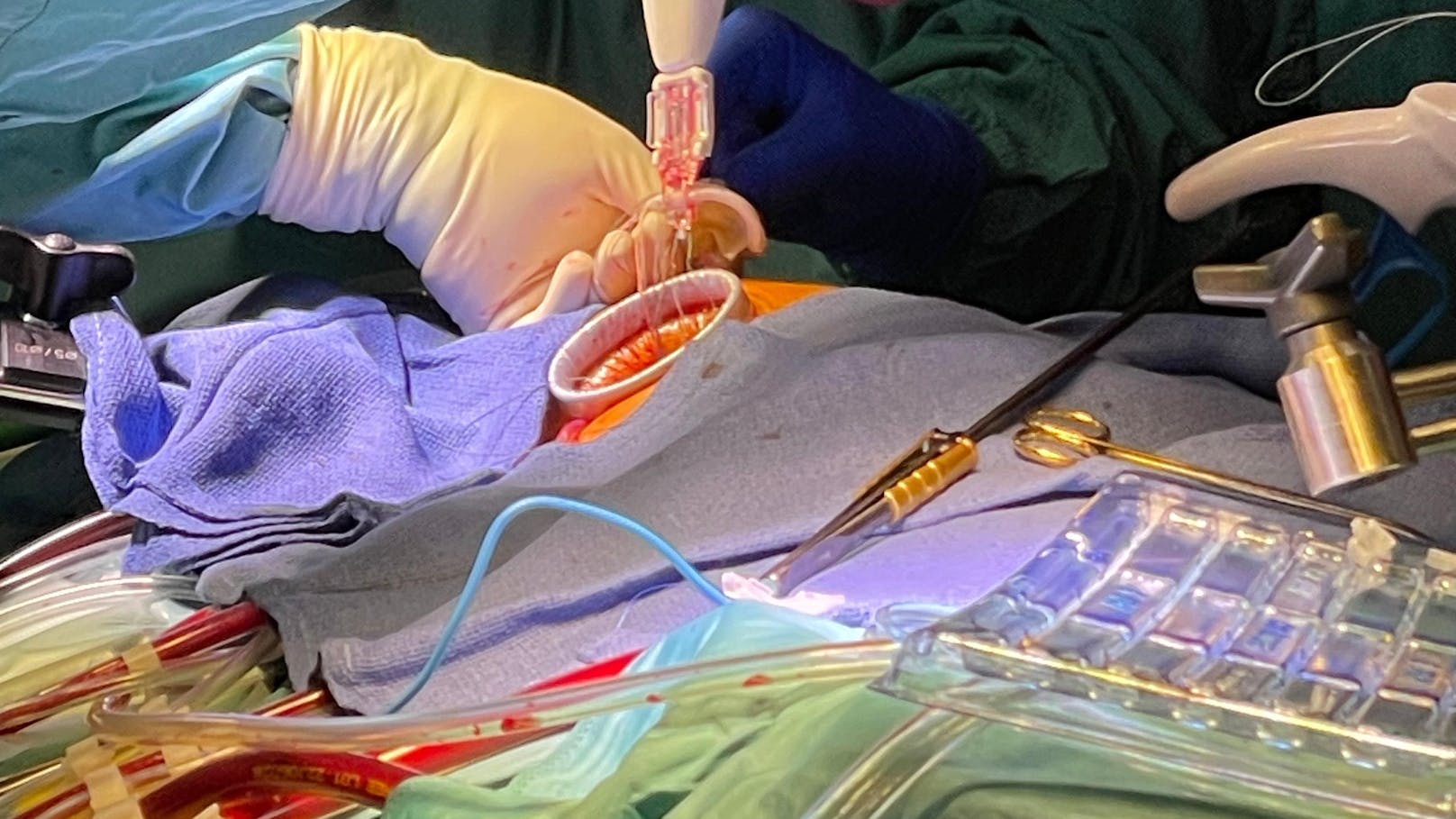 Am AKH Wien wurde erstmals erfolgreich eine minimal-invasive Methode angewandt, um die Trikuspidalklappe zu operieren. 