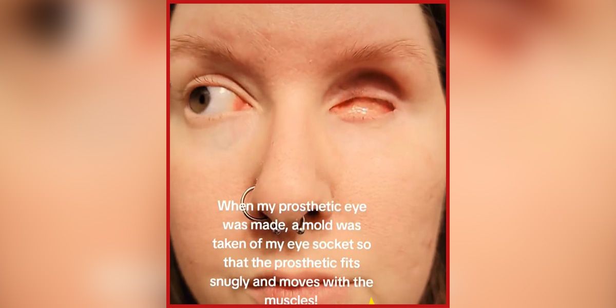 Michelle Timms (Bild) lebt heute mit einem eigenen Auge – und verschiedenen Prothesen in den buntesten Farben.