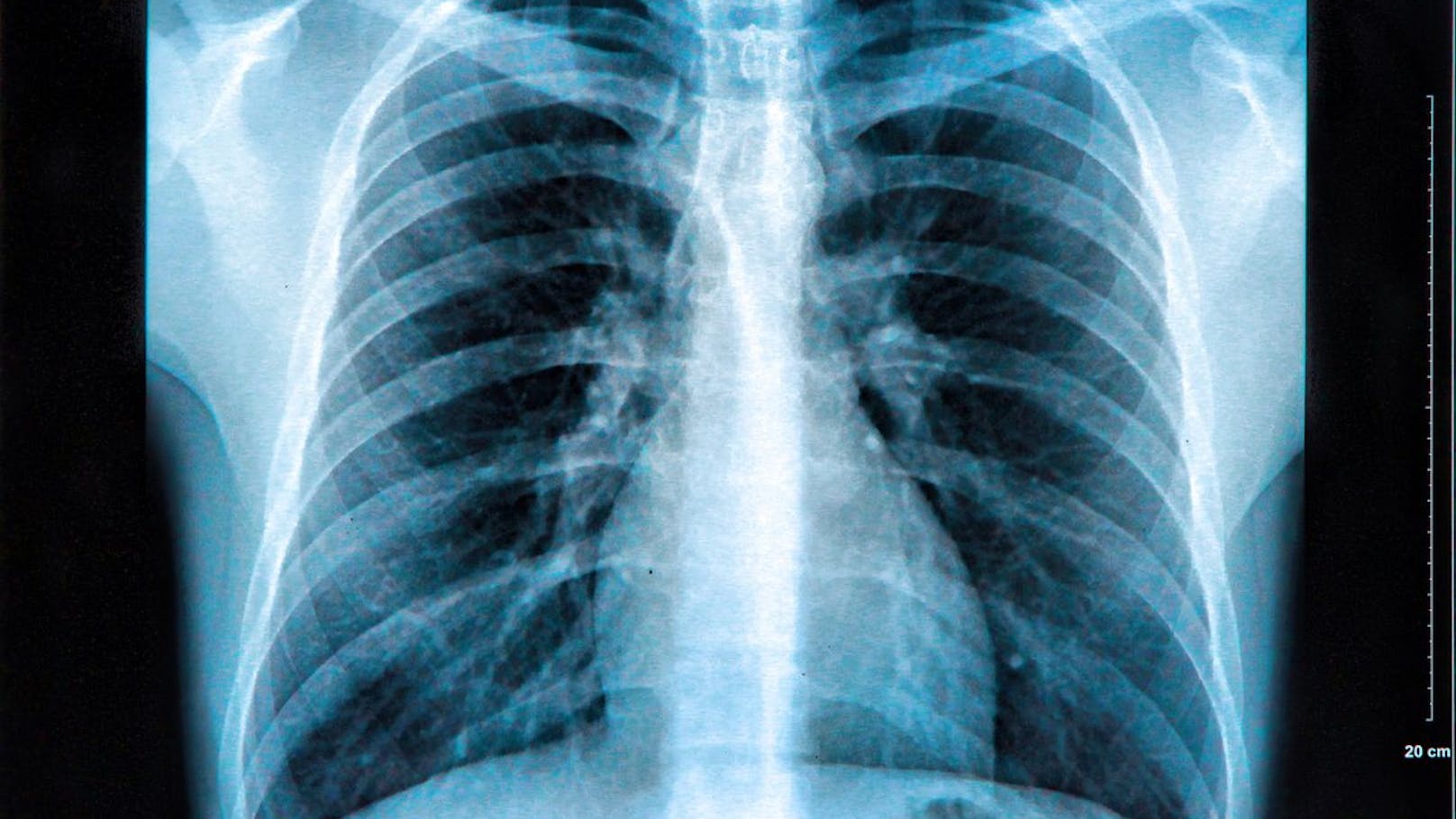 Diese 12 Lungenkrebssymptome weisen Nichtraucher auf