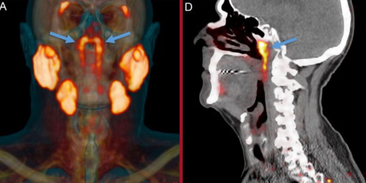 Die Tubariusdrüse (blaue Pfeile) befindet sich im Nasenrachenraum.