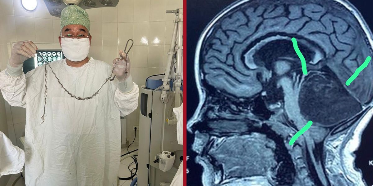 Die meterlange Haarsträhne (links) nach der OP und auf dem Gehirnscan (rechts).