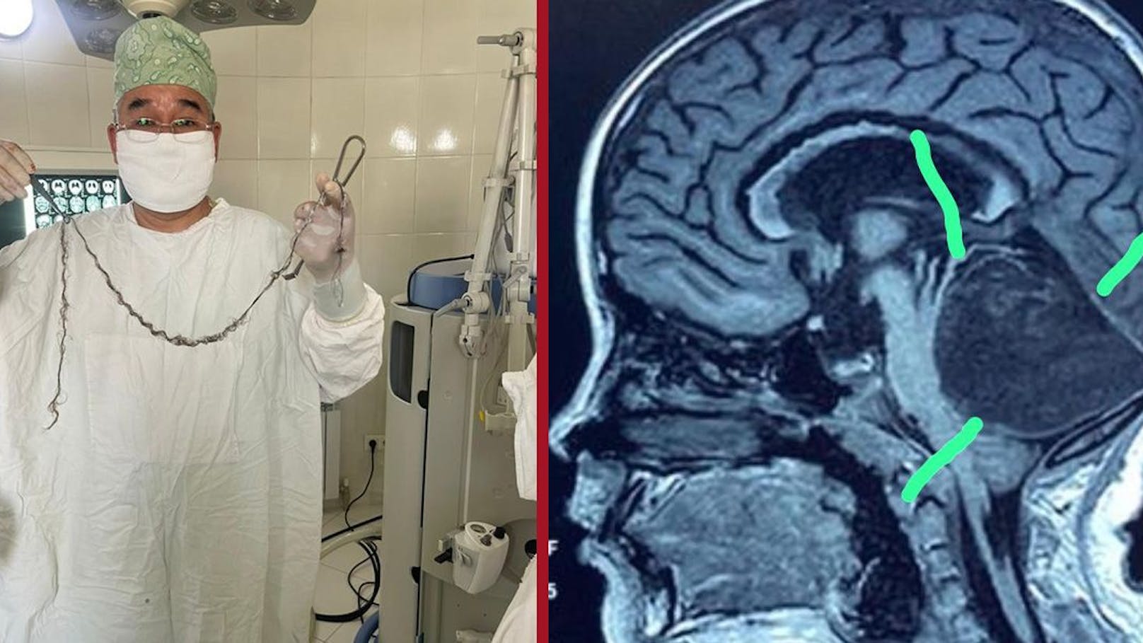 Ärzte entfernen Mädchen meterlange Haarlocke aus Gehirn