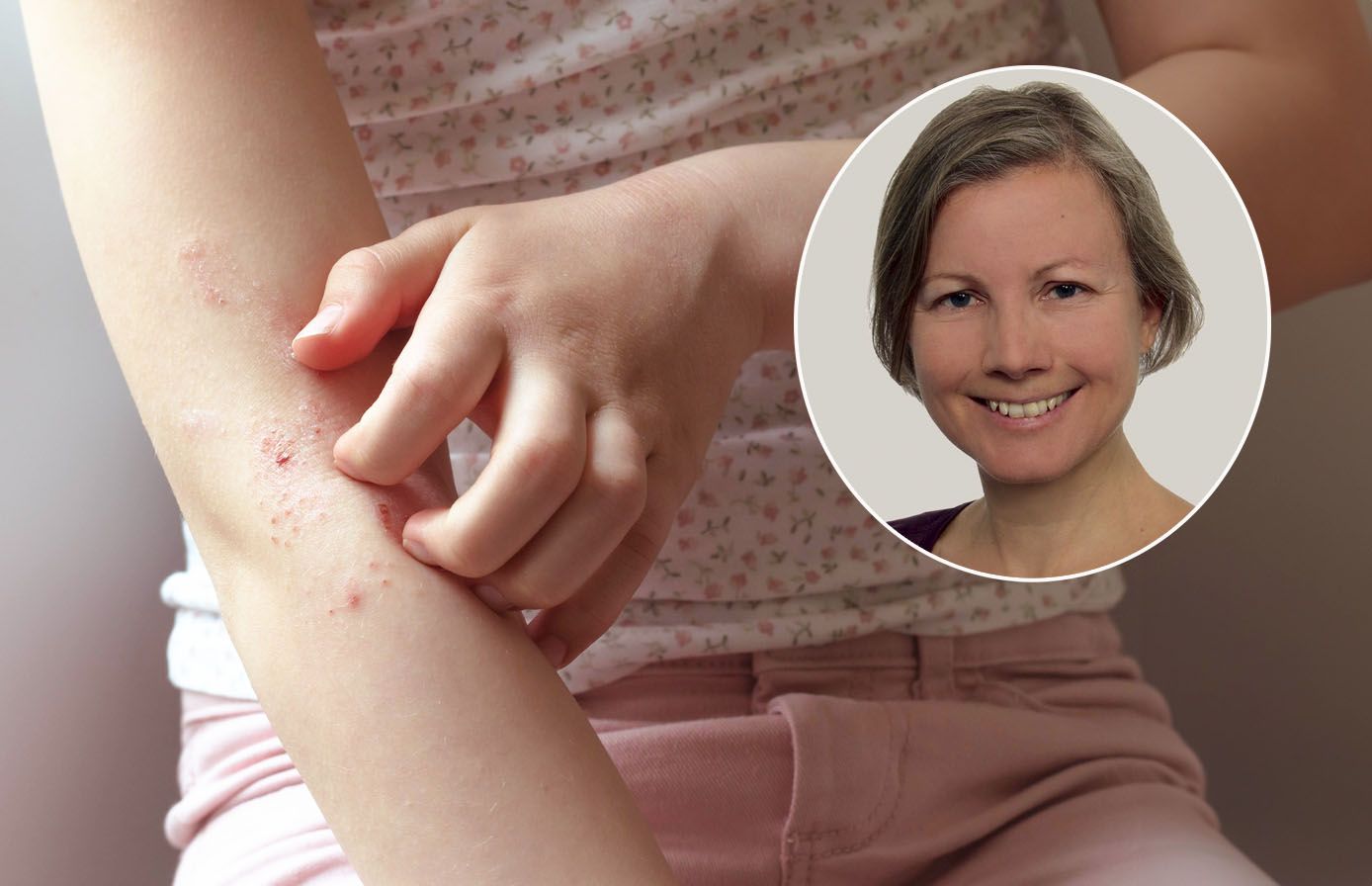 Katharina Ziegelbauer litt besonders in ihrer Jugend unter Neurodermitis.