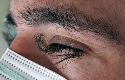 Mit diesen übermäßig langen Wimpern (Bild) war der Patient konfrontiert.