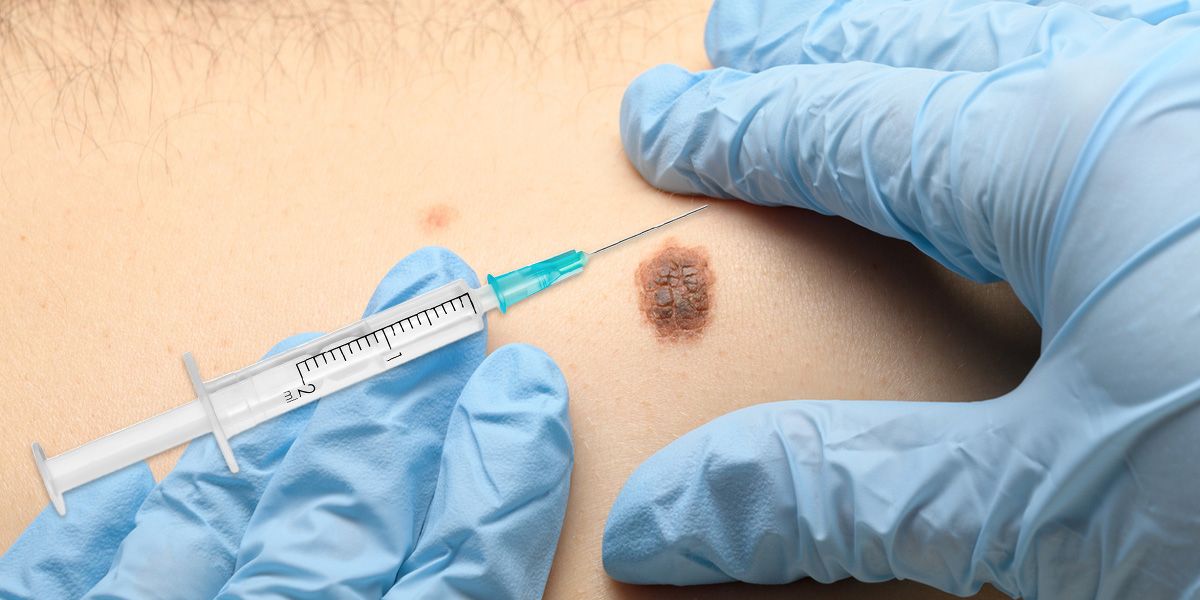 Um Hautkrebs vorzubeugen braucht es Sonnenschutz und jährliche Muttermal-Checks beim Hautarzt.