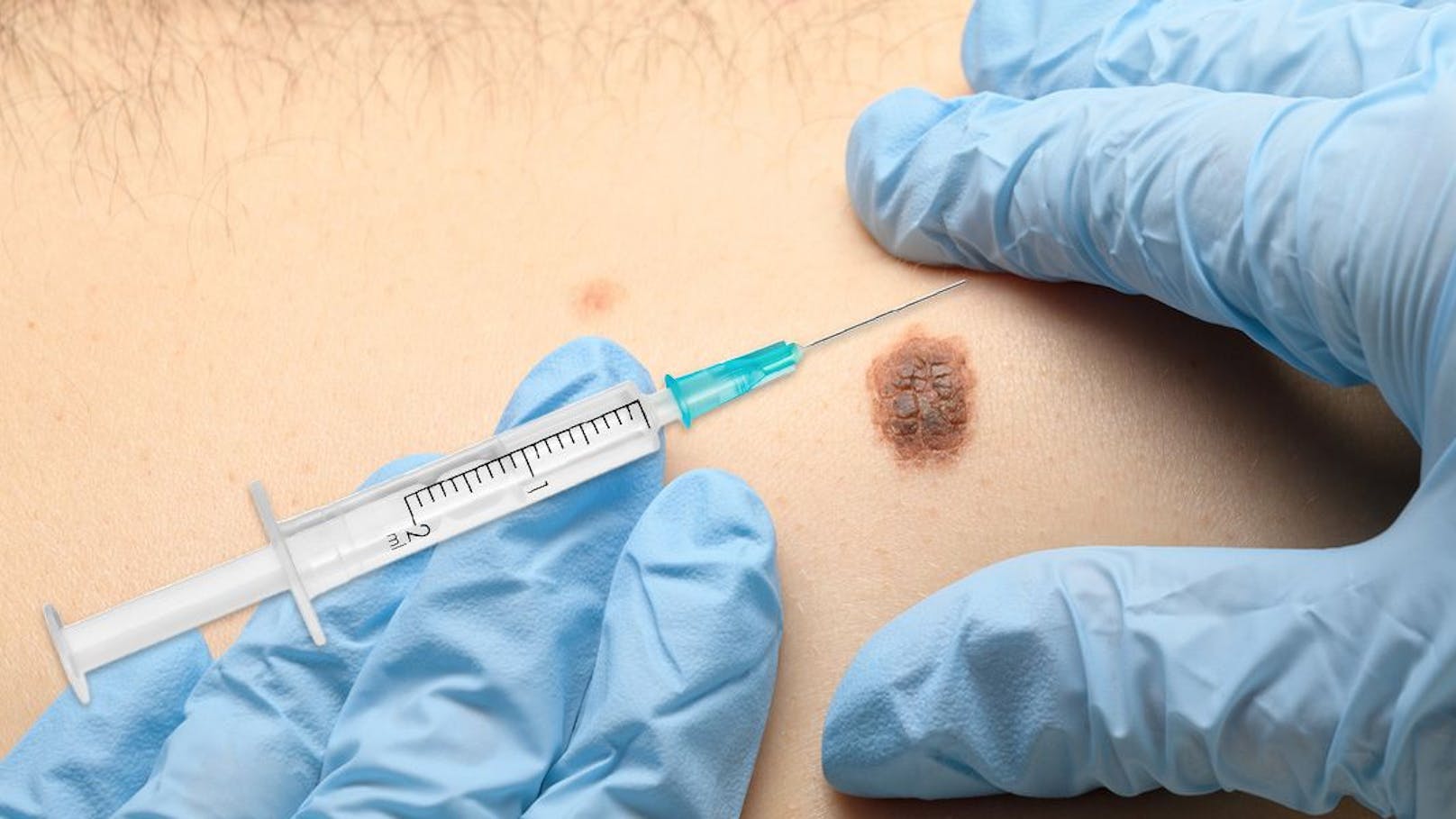 Mann bekommt weltweit erste Hautkrebs-Impfung