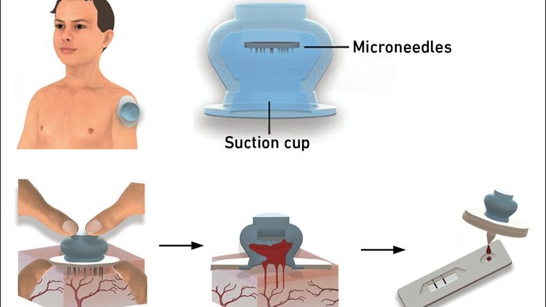 So funktioniert der Saugnapf zur Blutabnahme