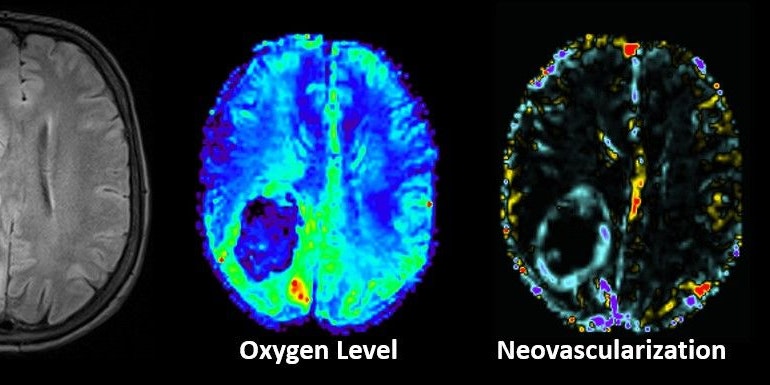 Dank Künstlicher Intelligenz kann rascher diagnostiziert werden, ob ein Gliom entsprechende Gen-Mutationen aufweist.