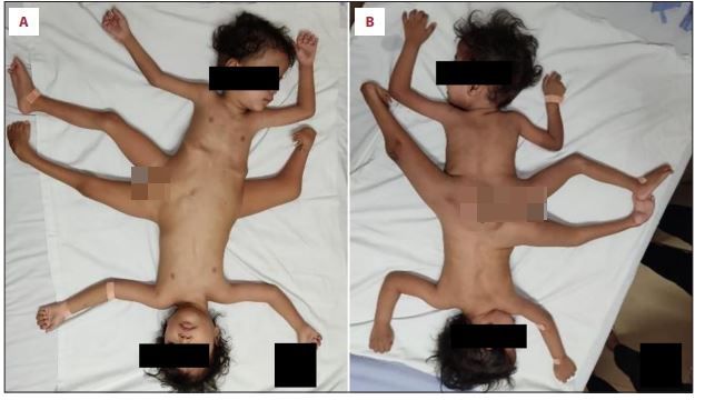 Die Buben sind am Becken zusammengewachsen.