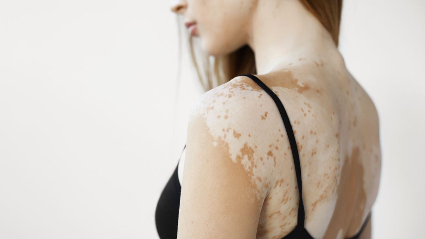 Hauterkrankung Vitiligo immer besser behandelbar