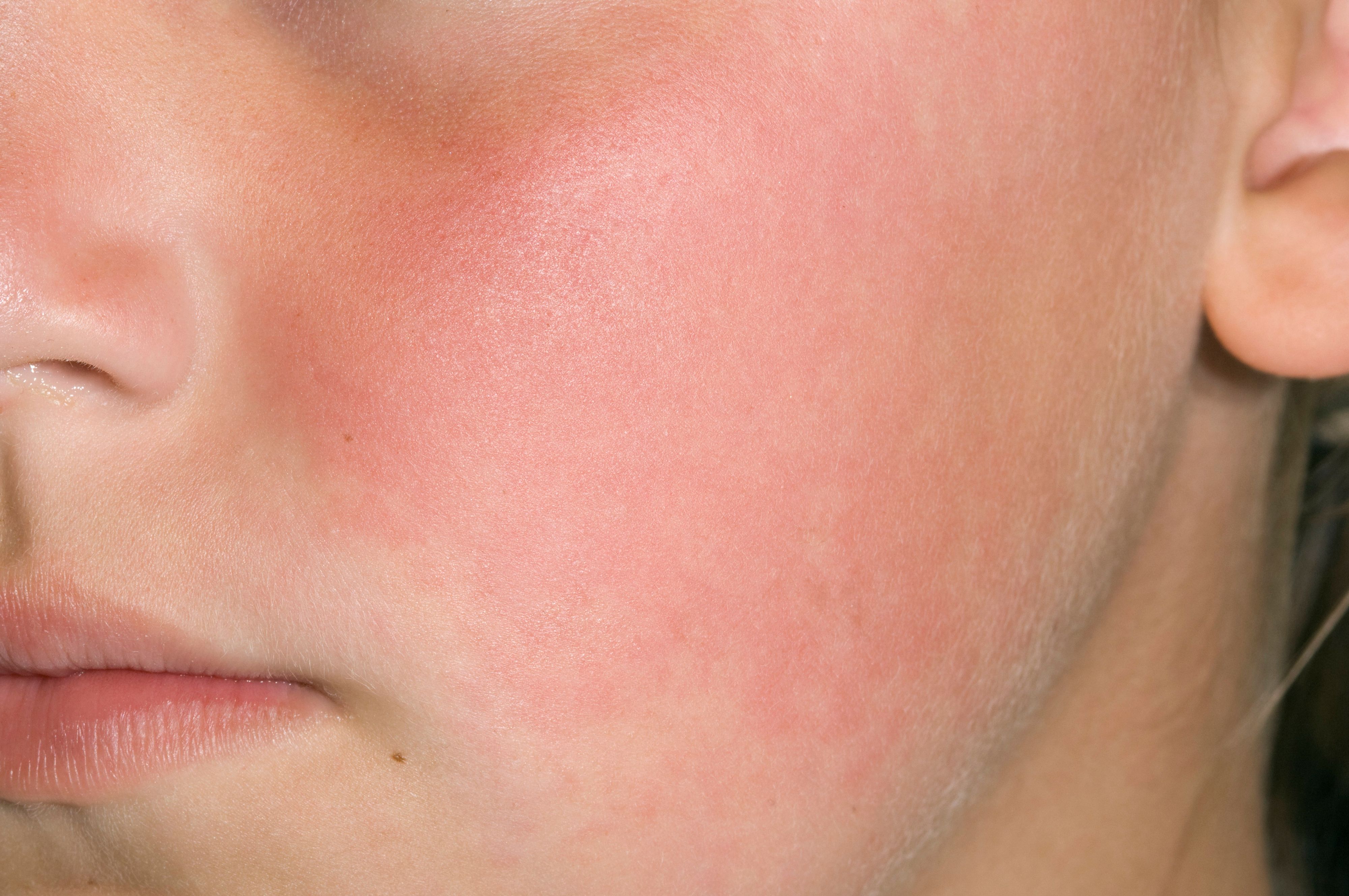 Ringelröteln bilden einen roten Ausschlag im Gesicht und an Armen und Beinen aus.
