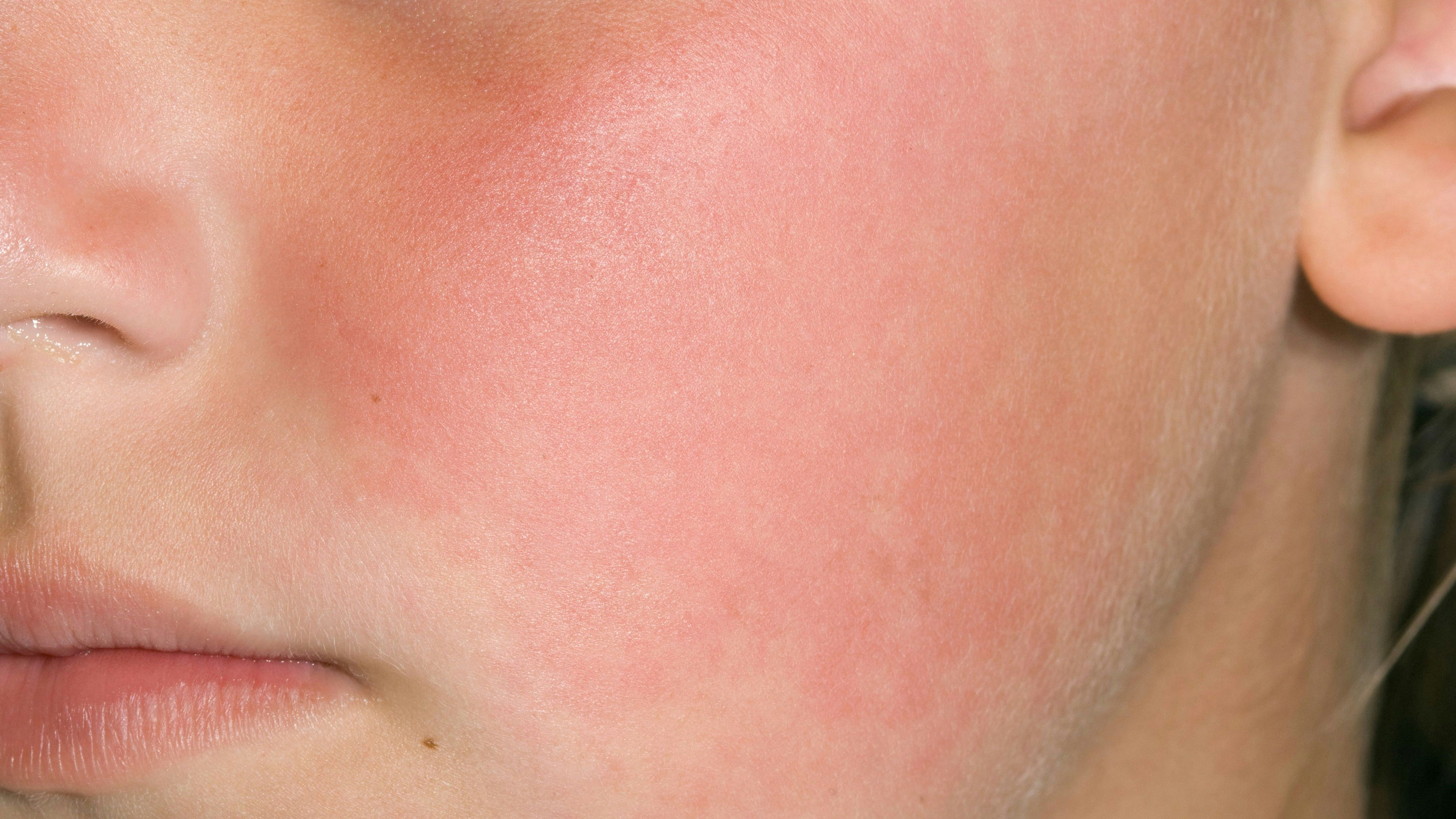 Download von www.picturedesk.com am 17.05.2024 (16:57).  Close-up of the red cheek in a 9 year old girl with Fifth disease (known also as slapped cheek disease or erythema infectiosum). It is caused by the parvovirus B19 virus, is most common in children aged 5 to 15, and symptoms may include fever. - 20101209_PD6354 - Rechteinfo: Rights Managed (RM)