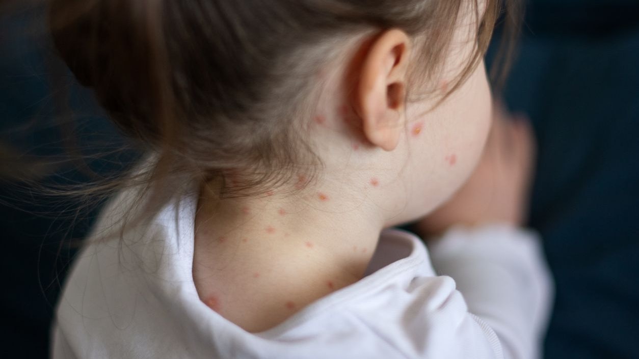 Heute.at - Impfmuffel, Migranten: Mehr Masern- und Hepatitis-Fälle