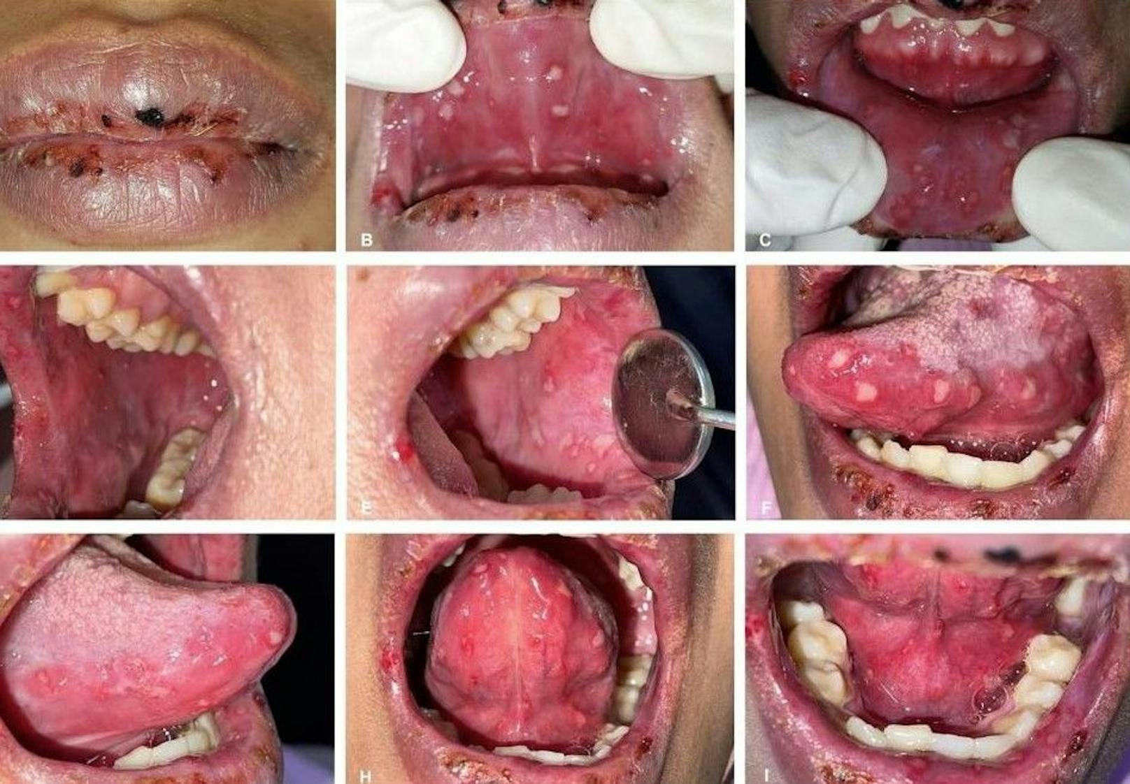 Die Innenseite des Mundes, der Wangen und der Zunge der Patientin waren mit gelblichen Geschwüren bedeckt.